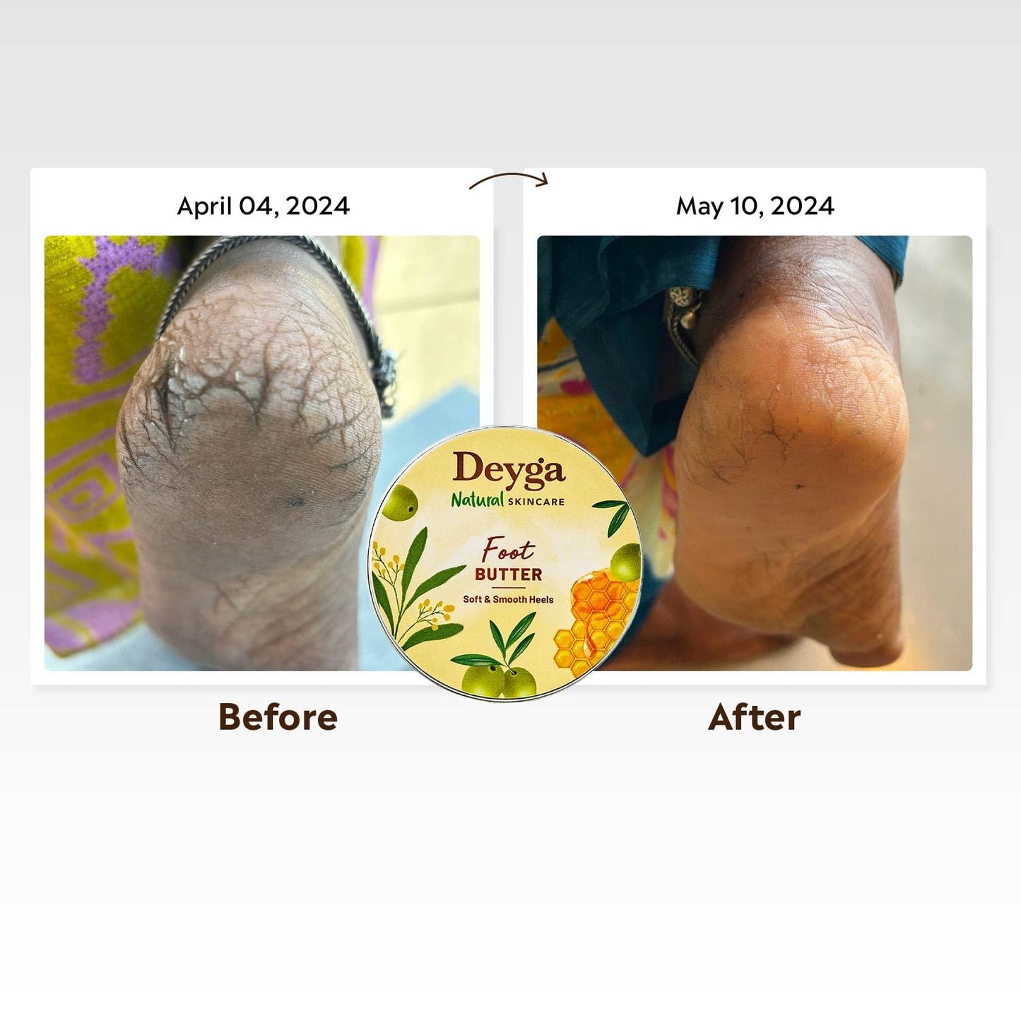 Foot Cream | For Dry, Rough, And Cracked Feet | Moisturizes Rough Heels | Suits both Men & Women | 40 Grm - Deyga Natural Skincare